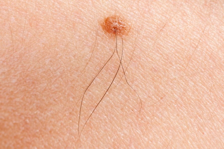 Can Electrolysis Be Performed On Moles?