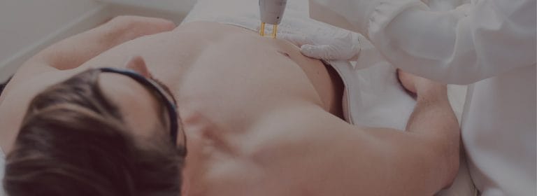 Electrolysis Chest Hair Removal