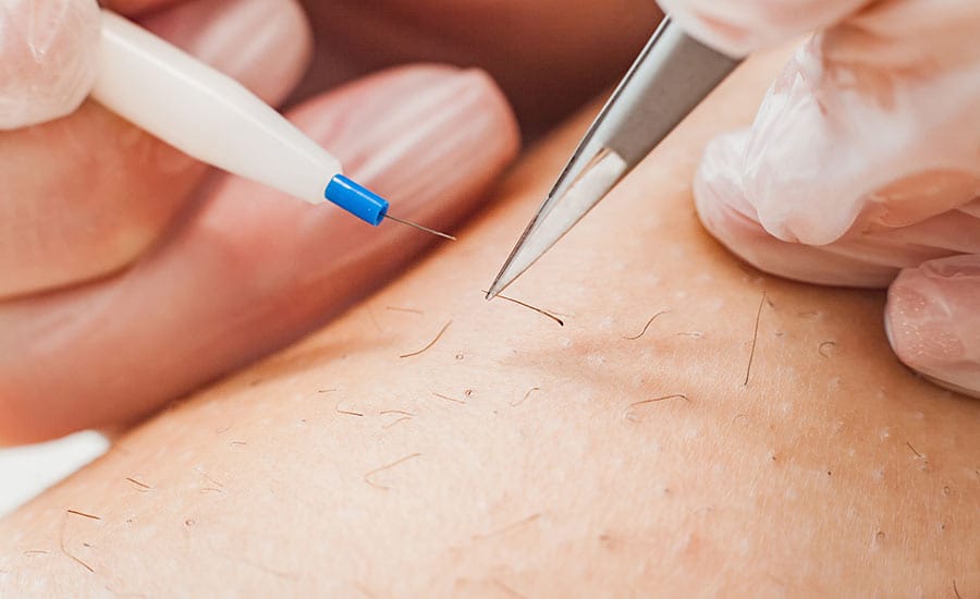 An electrolysis technician holding a needle and tweezer​